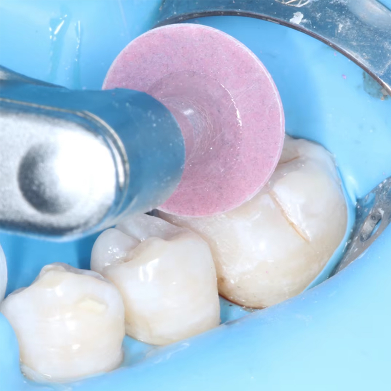 40 Stuks Tandheelkundige Polij - Teeth Whitening Home recensie en prijs