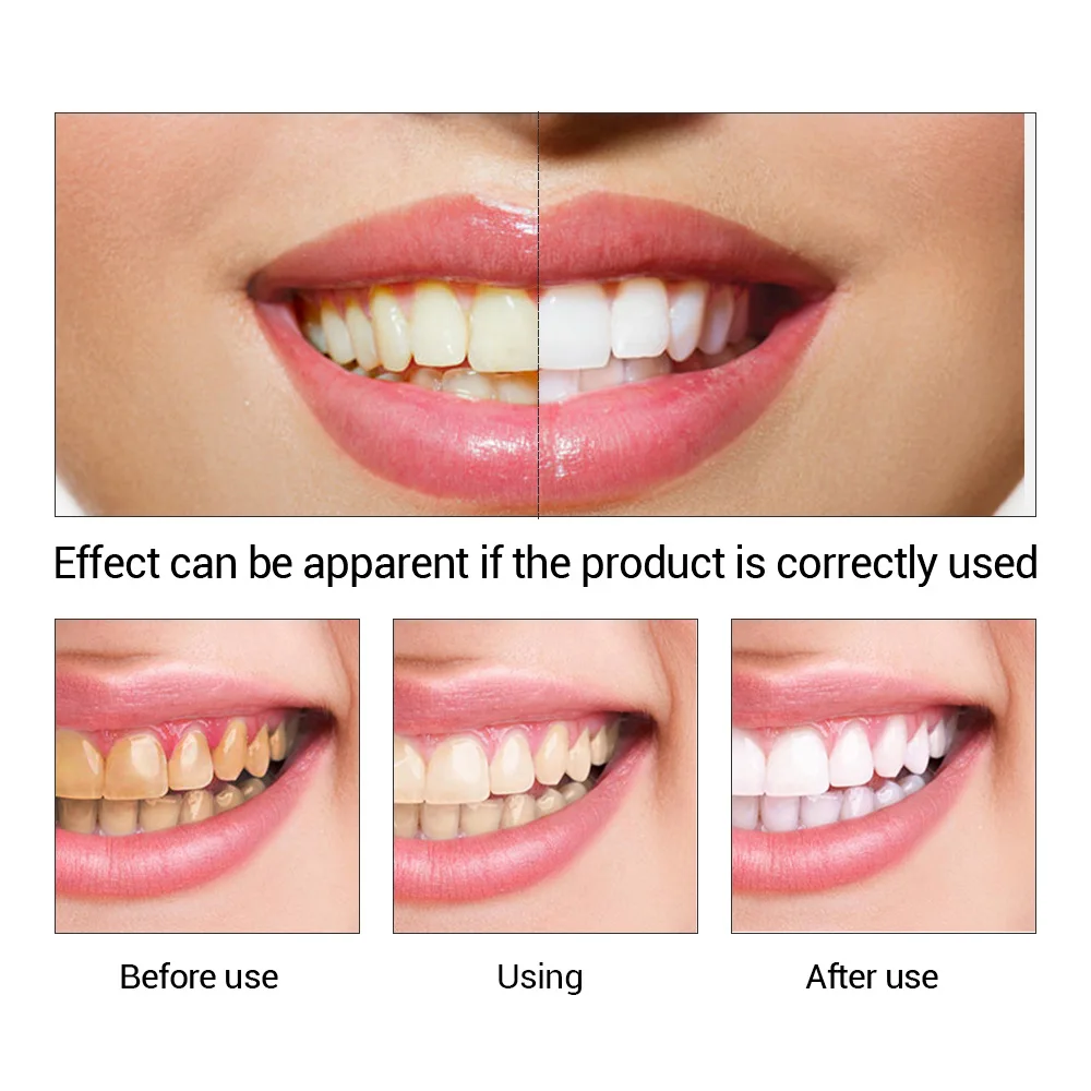 Fteenply Tanden Whitening Esse - Teeth Whitening Zimba recensie en prijs